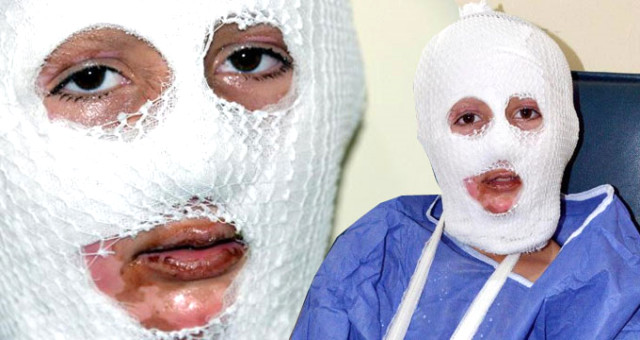 Patlayan parfüm şişesi küçük çocuğun yüzünü yaktı