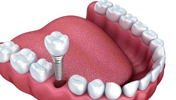 'Türkiye'de yılda 400 bin implant yapılıyor'