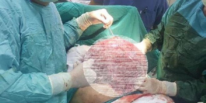 Karın ağrısı şikayetiyle gitti, karnından 11 kilo ur çıktı