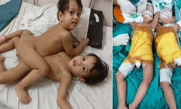 Başlarından yapışık doğan ikizler 16 saat süren ameliyatla ayrıldı