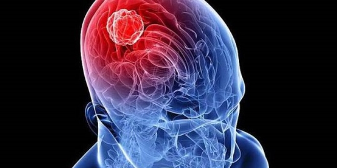 'Beyin tümörlerinde erken teşhis önemli'