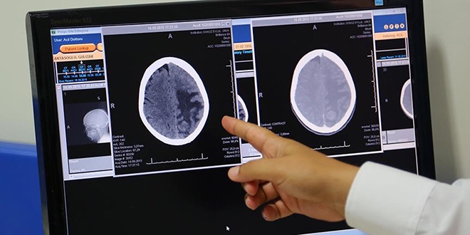 'Beyin damarındaki tıkanıklıkta 'stent' hayat kurtarıyor