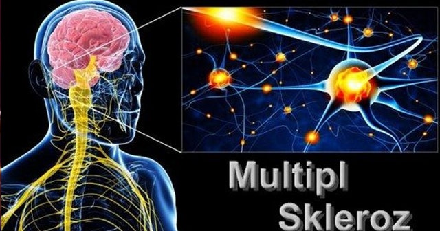 Multipl Sklerozda 'ezber bozan' tedavi