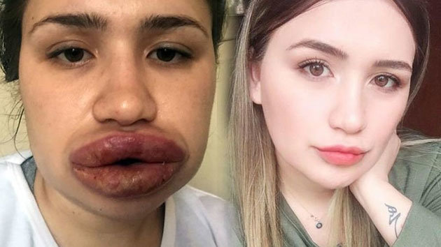 Kuaföre dudak dolgusu yaptıran Merve Keleş'in doktoru: Dünyada görülmemiş bir vaka