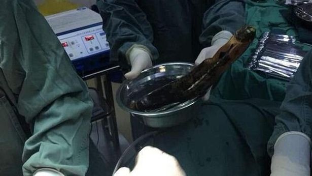 30 cm'lik patlıcan ile doktorları şoke eden tedavi yöntemi