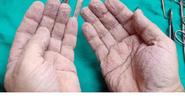 Ameliyat sonrası ellerini paylaşan cerrah sosyal medyayı salladı