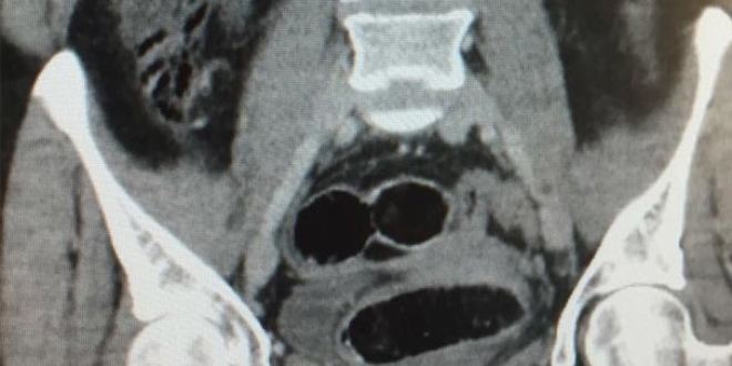 Yabancı uyruklu kadının midesinden 7 paket uyuşturucu çıktı