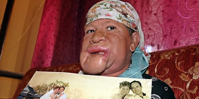 Çenesinde çıkan sivilceyi önemsemedi, hayatı karardı