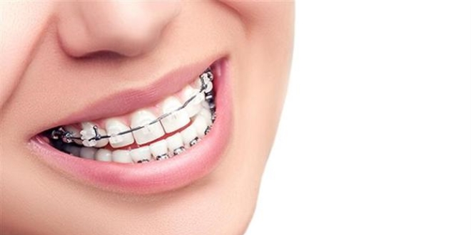 Diş teli olanlarda ağız bakımına dikkat
