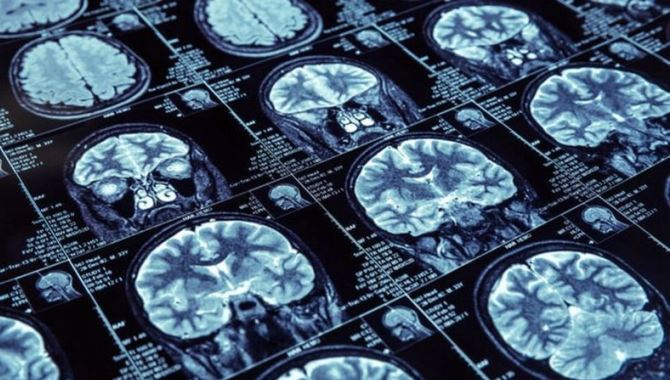 Beyin pili ile parkinsonda koku duyusunun geri getirildiği saptandı