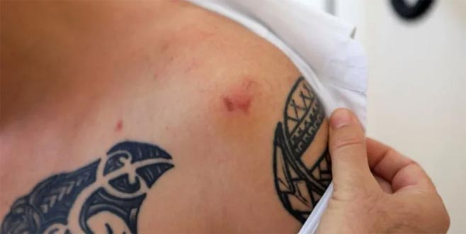 Tartıştığı kişi tarafından ısırılınca kuduz aşısı yapıldı