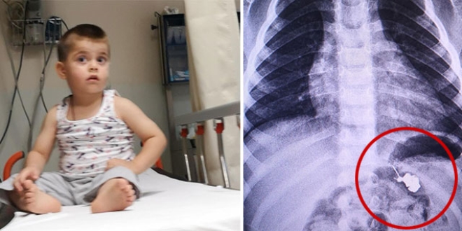 3 yaşındaki Yasin'in yuttuğu çengelli iğne çıkarıldı