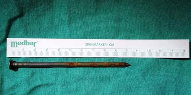 91 yaşındaki hastanın akciğerinden çıkan şaşırttı