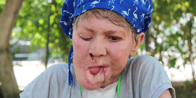 Çenesinde çıkan sivilce hayatını kararttı, kızının derdine düştü