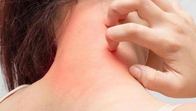 İlaç firmaları uyuz hastalığında yoğun talebe hazırlıksız yakalandı