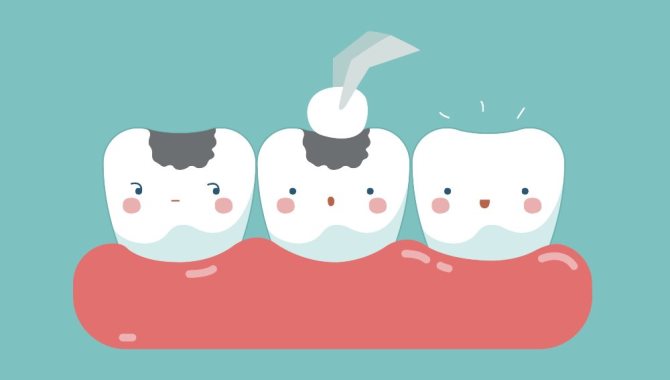 Diş Dolgusu ile İlgili Merak Edilenler Nelerdir?
