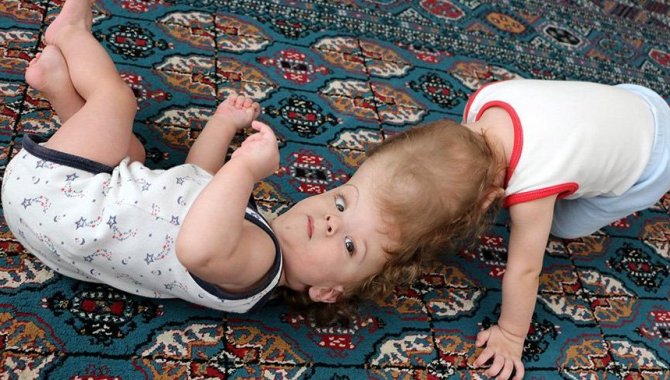 Ameliyatla ayrılan siyam ikizlerinden biri yürümeye, diğeri destekle ayakta durmaya başladı