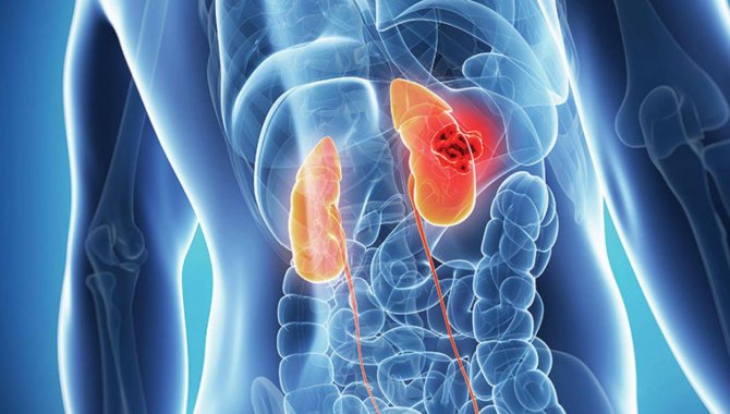 Karnında 4 kilogramlık tümör bulunan Suriyeli Muhammed Türkiye'de şifa buldu