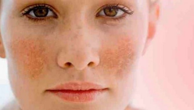 Gebelik maskesi hastalığı esmer ciltlerde daha sık görülüyor