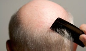 Sağlık Bakanlığı kellik ilacına sıkı denetim getirdi