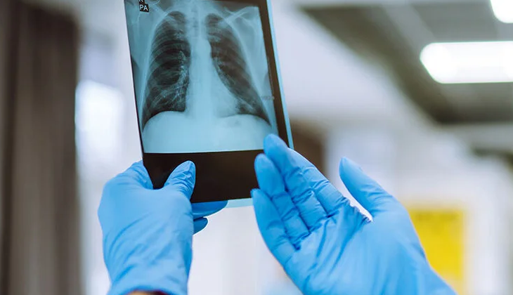 Kovid-19 sürecinde dünyada tüberküloz tanı oranı düştü, hastalığa bağlı ölümler arttı