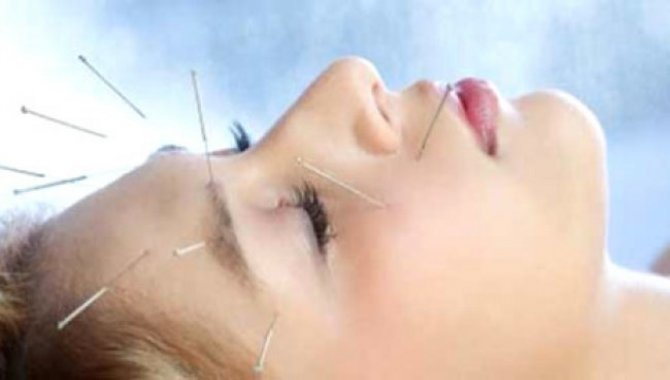 Migrende Akupunktur Tedavisi