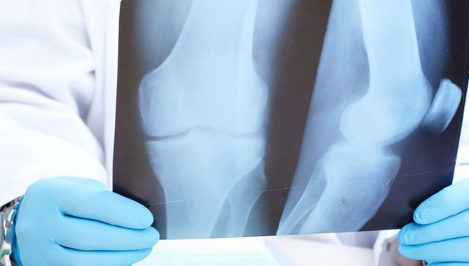 Kemik Tümörünün Belirtileri