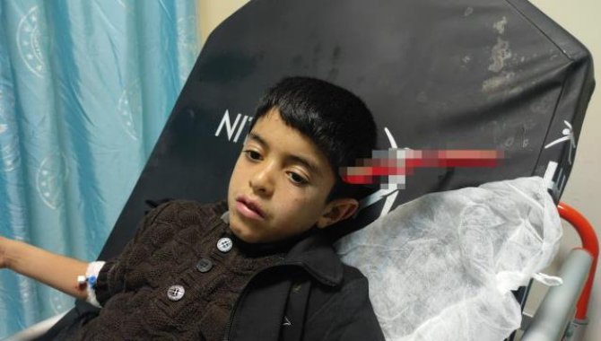 Siirt'te 10 yaşındaki çocuğun kafasına saplanan makas operasyonla çıkarıldı