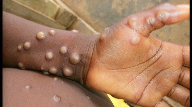 Kongo Demokratik Cumhuriyeti'nin bir eyaletinde "maymun çiçeği salgını" yaşandığı duyuruldu