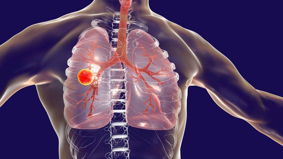 Türkiye'de vereme bağlı ölümler dünya ve Avrupa ortalamasının altında seyrediyor