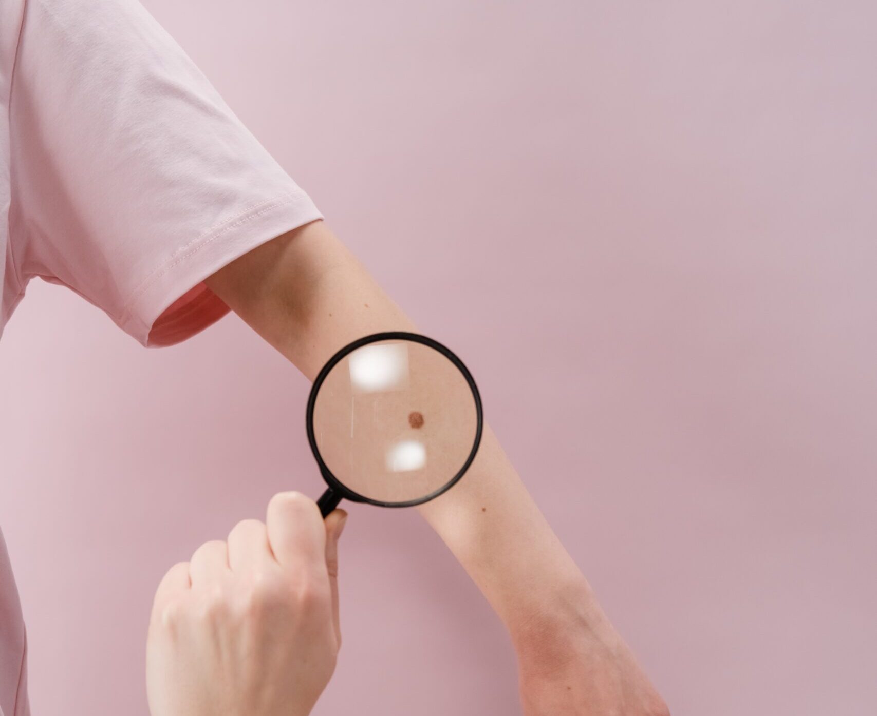 Açık Tenliler Ben Oluşumu Risk Altında!