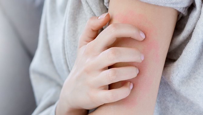 Türkiye'de uyuz vakaları yüzde 50 arttı