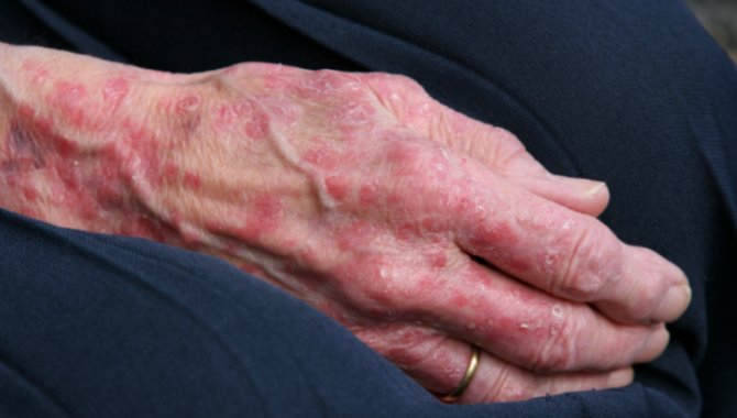 Cüzzam Hastalığı Nedir ?