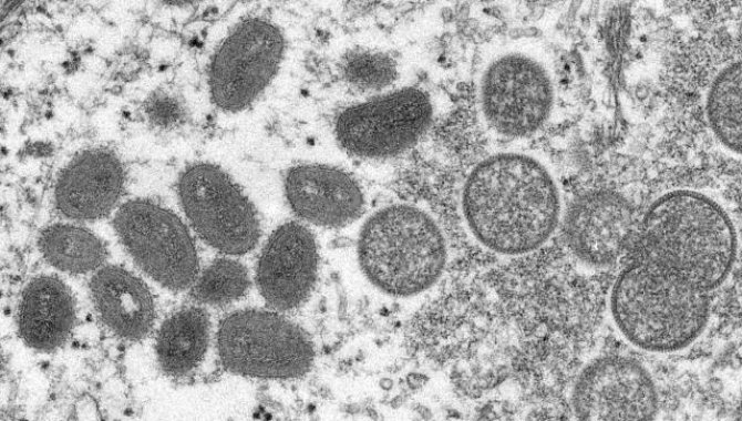 ABD'de 2022'nin ilk maymun çiçeği virüsü vakası tespit edildi