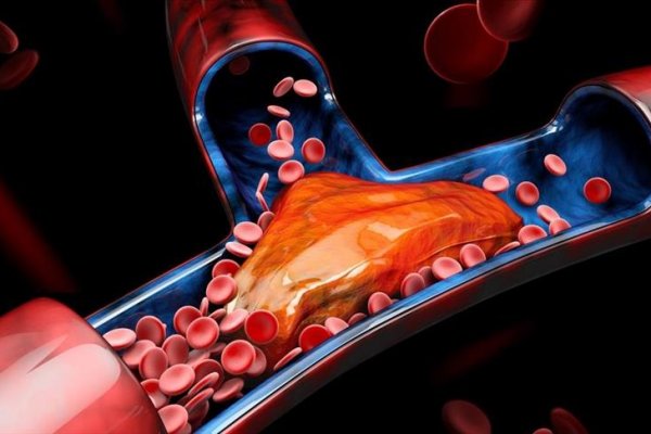 Venöz tromboembolizm, dünyada her 37 saniyede bir can alıyor