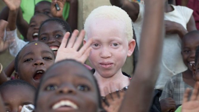 Afrikalı albinolar "beyaz" bir gelecek ümidiyle yaşıyor