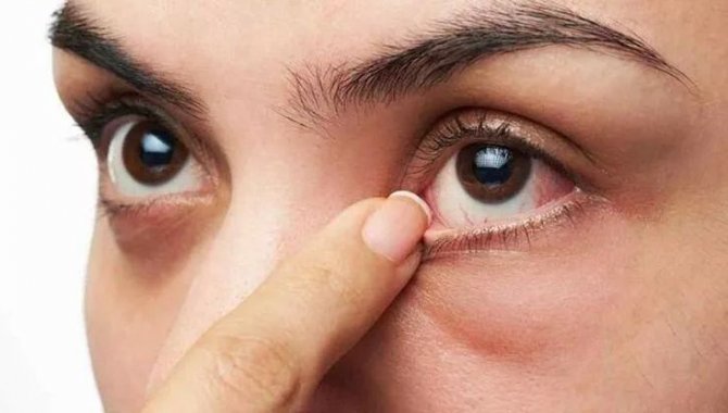 Yazın artan göz yaralanmalarından basit önlemlerle korunma önerisi