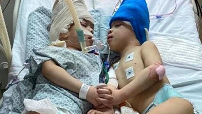 Brezilyalı yapışık ikizler sanal gerçeklik teknolojisiyle ayrıldı