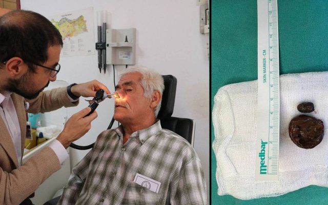 Zonguldak'ta 50 yıldır yüz kemiğinde kurşunla yaşayan hasta ameliyat edildi