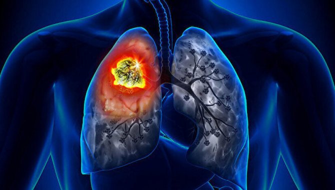 Yaşanılan yer ve yapılan iş akciğer kanserinin sebebi olabiliyor