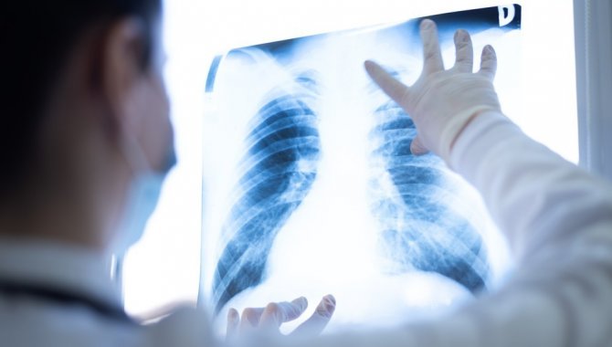 “Ciğerlerde Kalan Covid-19 Nodülleri Akciğer Kanseri Başlangıcı Olabilir”