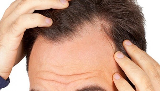 Kök Hücre Tedavisi İle Saç Dökülmesini Durdurun