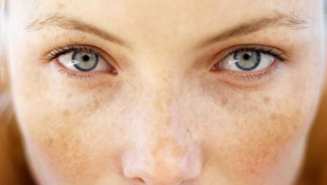 Güneşle Gelen Cilt Lekelerine Dikkat