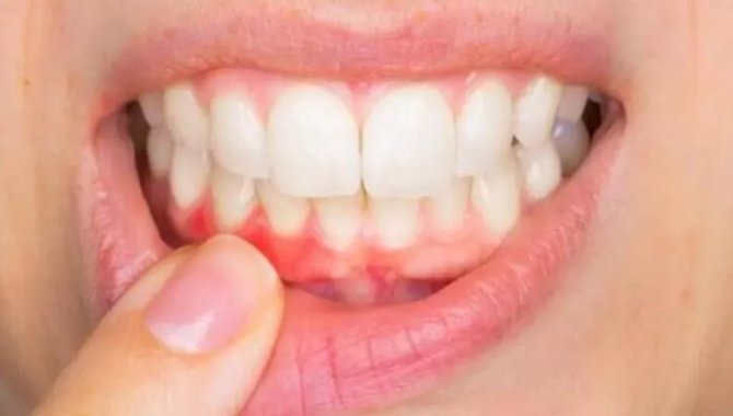 Diş eti hastalıkları yetişkinlerdeki diş kayıplarının en önemli nedeni olarak görülüyor