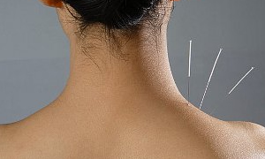 'Akupunkturdan sonra kilo alınır' efsanesi gerçek mi?