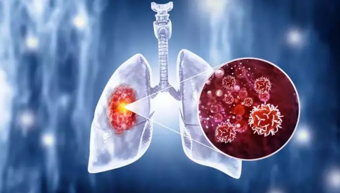 Kemer İlçe Sağlık Müdürlüğünden "Akciğer Kanseri Farkındalık Ayı" açıklaması