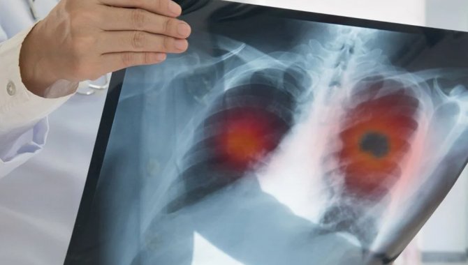 Zatürre Hastalığının Belirtileri