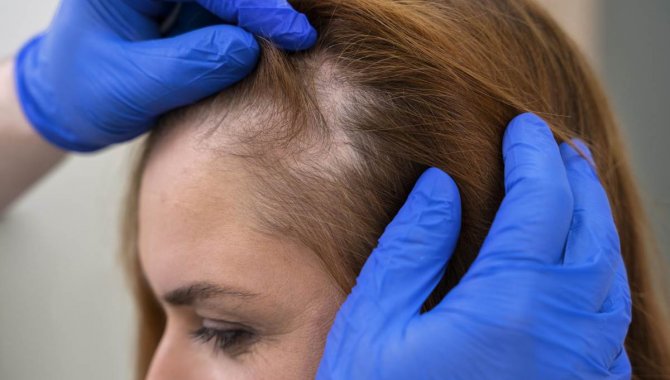 Uzm. Dr. Uzun, Saç Dökülmesi Ve Tedavisi Hakkında Bilgi Verdi