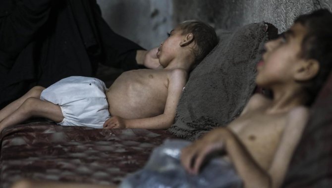 İsrail saldırısında yaralanan Gazzeli 2 kardeş, yetersiz beslenme nedeniyle iyileşemiyor