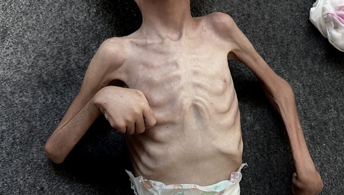 Gazze’de yetersiz beslenmeden ölen çocuklar insani krizin en acı yüzü oldu